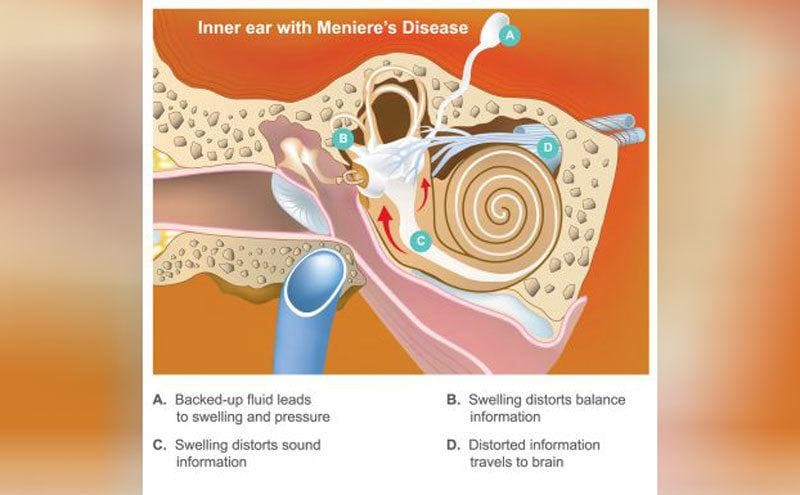 A diagram explaining the effects of Meniere's disease