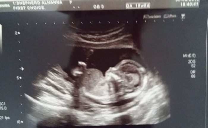 Ultrasound photo of a fetus 